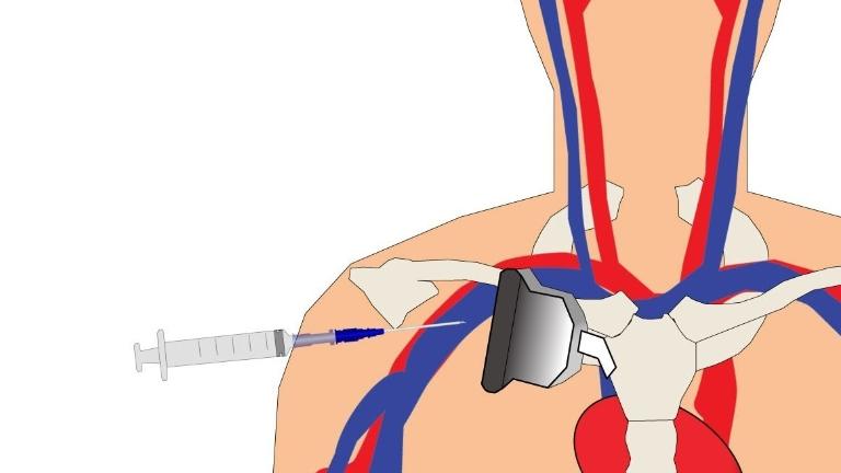 Catheter Động Mạch: Hướng Dẫn Về Quy Trình, Chăm Sóc và An Toàn 