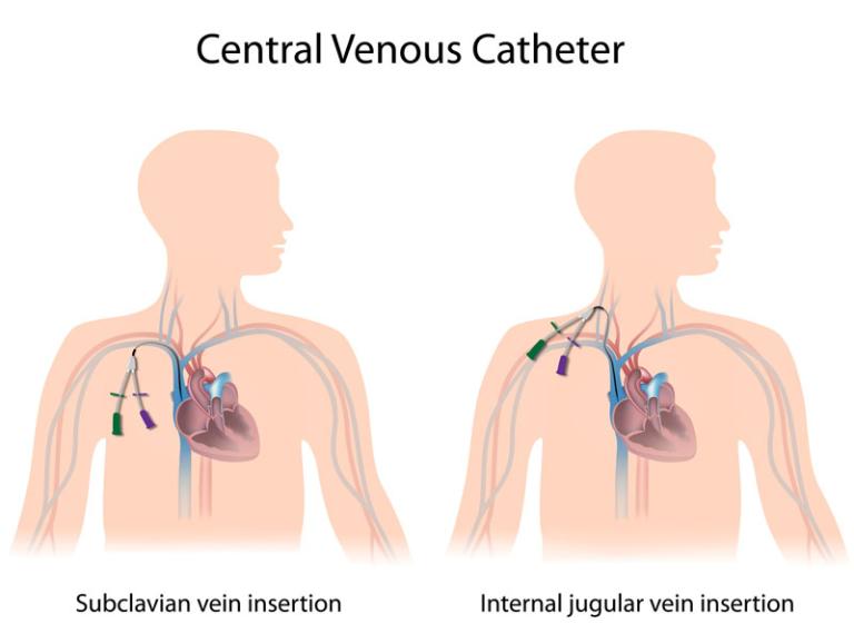 Chăm sóc và bảo dưỡng catheter trong quá trình điều trị