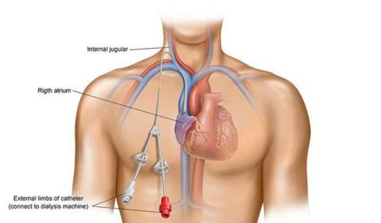 Đặt Catheter Tĩnh Mạch Trung Tâm - Hướng Dẫn Chi Tiết 7 Bước Quy Trình, Chỉ Định và Biến Chứng 