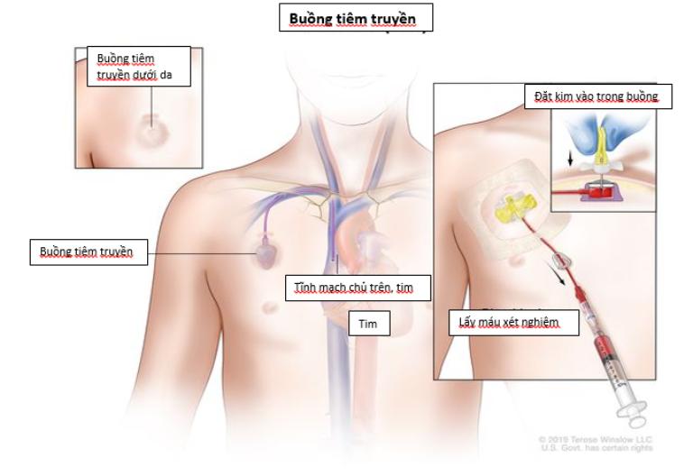 Vị Trí Đặt Lý Tưởng Và Tính Toán Chiều Dài Picc