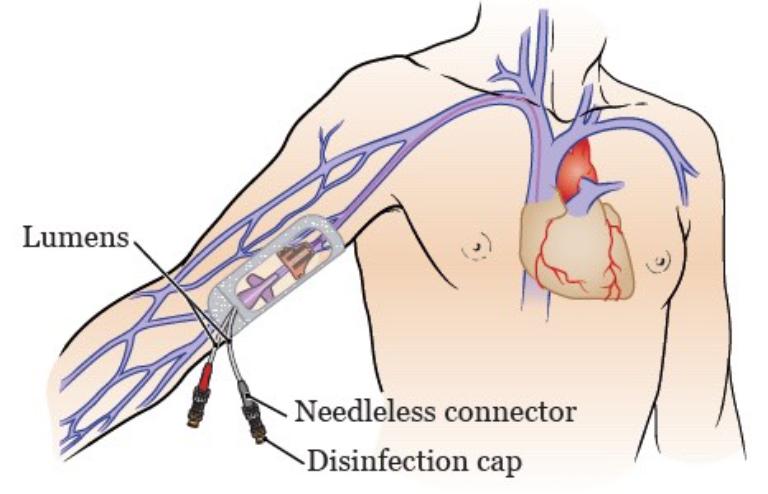 Lợi Ích Và Ưu Điểm Của Picc