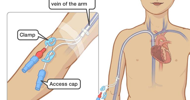 Quy Trình Đặt Picc Theo Kỹ Thuật Seldinger